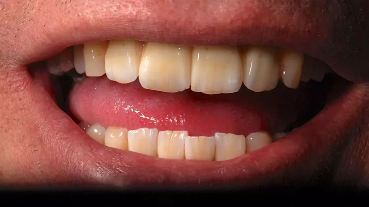 Abb. 15: Beide Rekonstruktionen fügen sich harmonisch in das orale Erscheinungsbild
des Patienten ein.