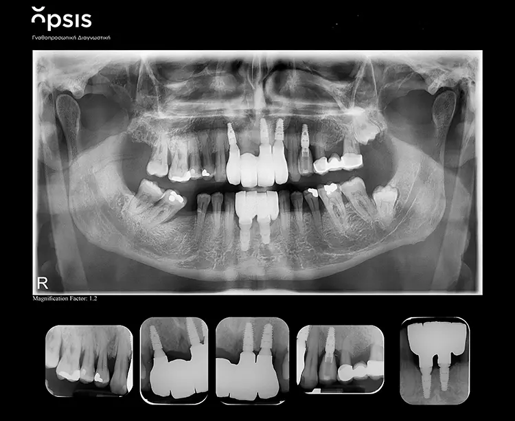 Abb. 16: Röntgenologischer Endbefund.