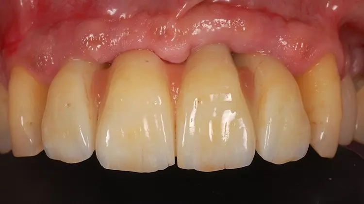 Abb. 17: Klinische Situation im Oberkiefer zum Zeitpunkt der Nachuntersuchung
nach annähernd zweieinhalb Jahren.