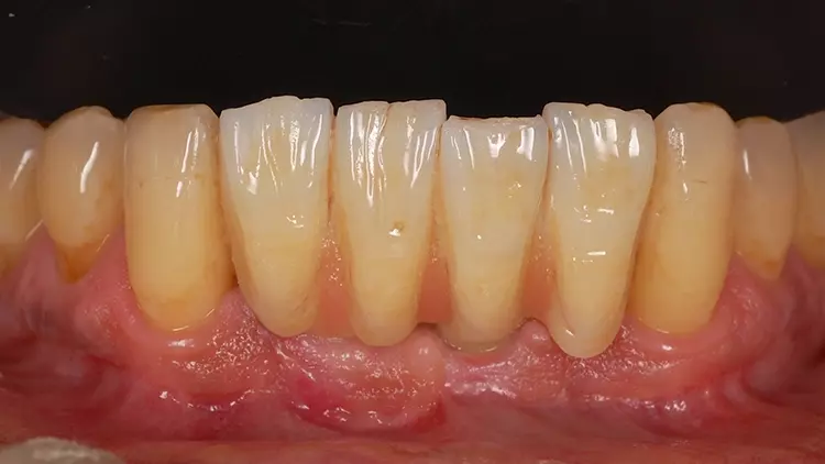 Abb. 18: Klinische Situation im Unterkiefer zum Zeitpunkt der Nachuntersuchung nach annähernd zweieinhalb Jahren.