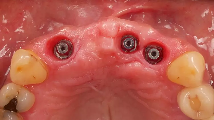 Abb. 19: Reizlose klinische periimplantäre Verhältnisse zum Zeitpunkt des Follow-
up nach Entfernung der verschraubten Suprakonstruktion im Oberkiefer.