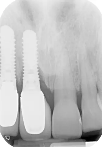 Abb. 1: Periimplantitis regio 11 mit radiologischem periimplantärem Knochenverlust. Das Nachbarimplantat in regio 12 imponiert radiologisch unauffällig.