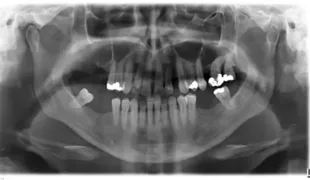 Abb. 1: Panoramaschichtaufnahme zeigt radiologische Ausgangssituation bei Erstvorstellung.