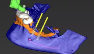 Abb. 1: DVT-Daten (blau) und Intraoralscan (orange) überlagert. 3D-gedrucktes Tray (weiß) mit Halterung für den Referenzmarker (grün). Geplante Implantatpositionen und Implantatachse (gelb) mit ausreichend Sicherheitsabstand zum Nervkanal (pink).