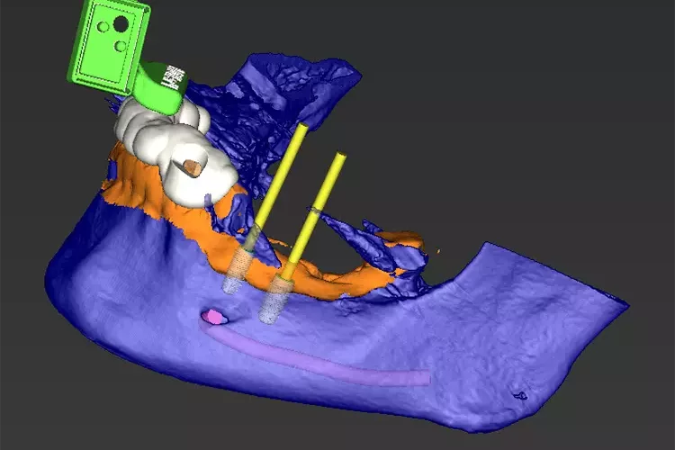 Abb. 1: DVT-Daten (blau) und Intraoralscan (orange) überlagert. 3D-gedrucktes Tray (weiß) mit Halterung für den Referenzmarker (grün). Geplante Implantatpositionen und Implantatachse (gelb) mit ausreichend Sicherheitsabstand zum Nervkanal (pink).