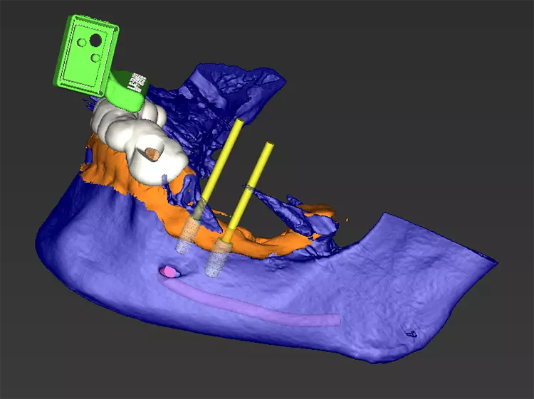 Abb. 1: DVT-Daten (blau) und Intraoralscan (orange) überlagert. 3D-gedrucktes Tray (weiß) mit Halterung für den Referenzmarker (grün). Geplante Implantatpositionen und Implantatachse (gelb) mit ausreichend Sicherheitsabstand zum Nervkanal (pink).