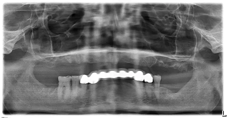 Abb. 1: Röntgenologische und klinische Ausgangssituation bei stark atrophiertem
Kieferkamm im Oberkiefer.