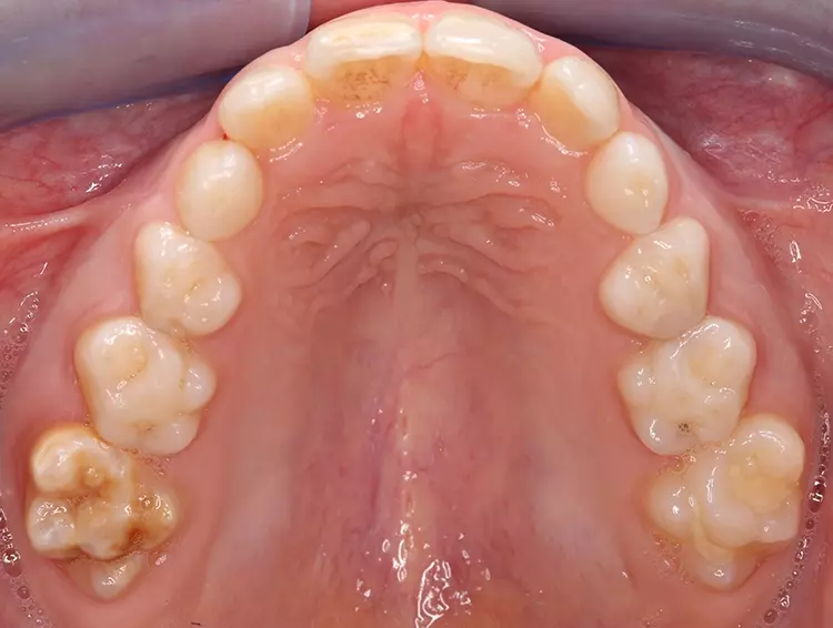 Abb. 1: Typisches klinisches Erscheinungsbild eines Molaren mit MIH (Foto: Prof.
Dr. Katrin Bekes, Universität Wien).