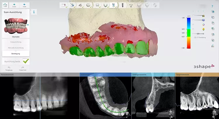 Abb. 1: Matching des 3D-Röntgenbildes im DICOM-Datensatz mit dem Oberflächendatensatz eines Intraoralscans. Die Genauigkeit des Matchings (± 250 µm) im Zahnbereich wird durch die Software (Implantstudio, 3Shape) farblich (grün) dargestellt und ermöglicht dem Anwendenden die optische Kontrolle.