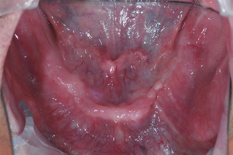 Abb. 1: Dünner, schmaler Alveolarkamm.
