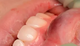 Schwellung der mittleren Oberlippe mit Verdacht auf vaskuläre
Malformation.