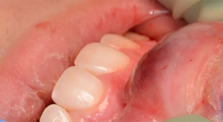 Schwellung der mittleren Oberlippe mit Verdacht auf vaskuläre
Malformation.
