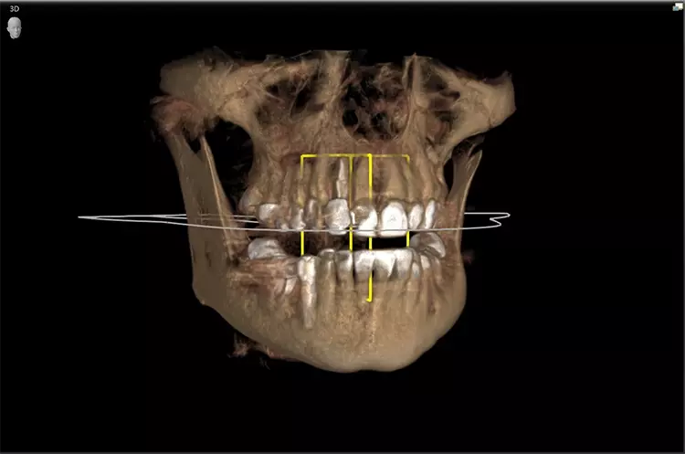 Abb. 1: CBCT-Aufnahme des lateralen Schneidezahns vor dem Ersatz durch ein SDS-Keramikimplantat.