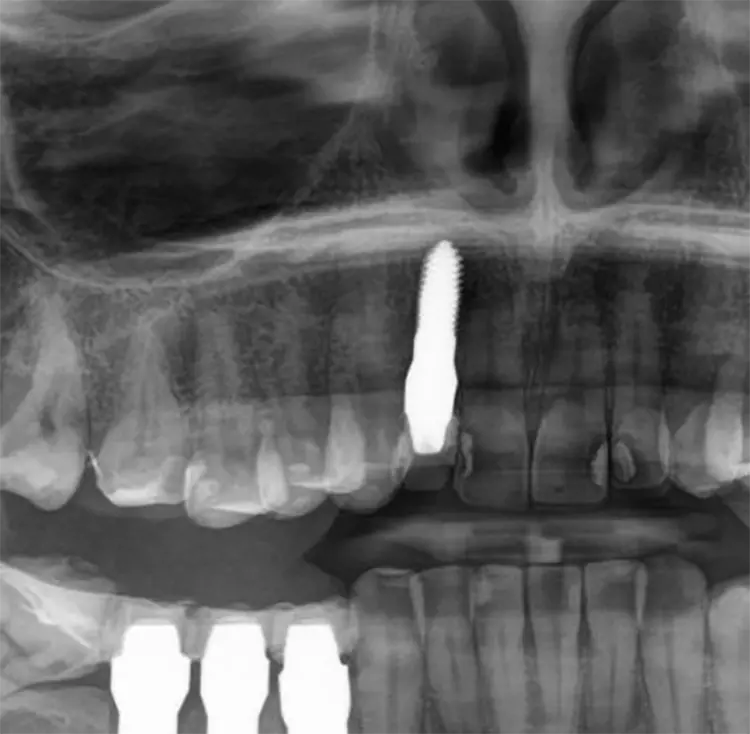 Abb. 3: Röntgenbild nach Sofortimplantation und Implantataufbereitung.