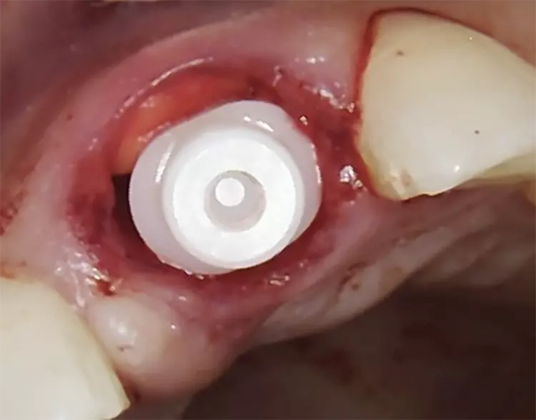 Abb. 5: Ovales Zirkonoxidimplantat nach Sofortimplantation. PRF-Matrizen füllen
den Raum zwischen dem Implantat und der bukkalen Knochenwand.