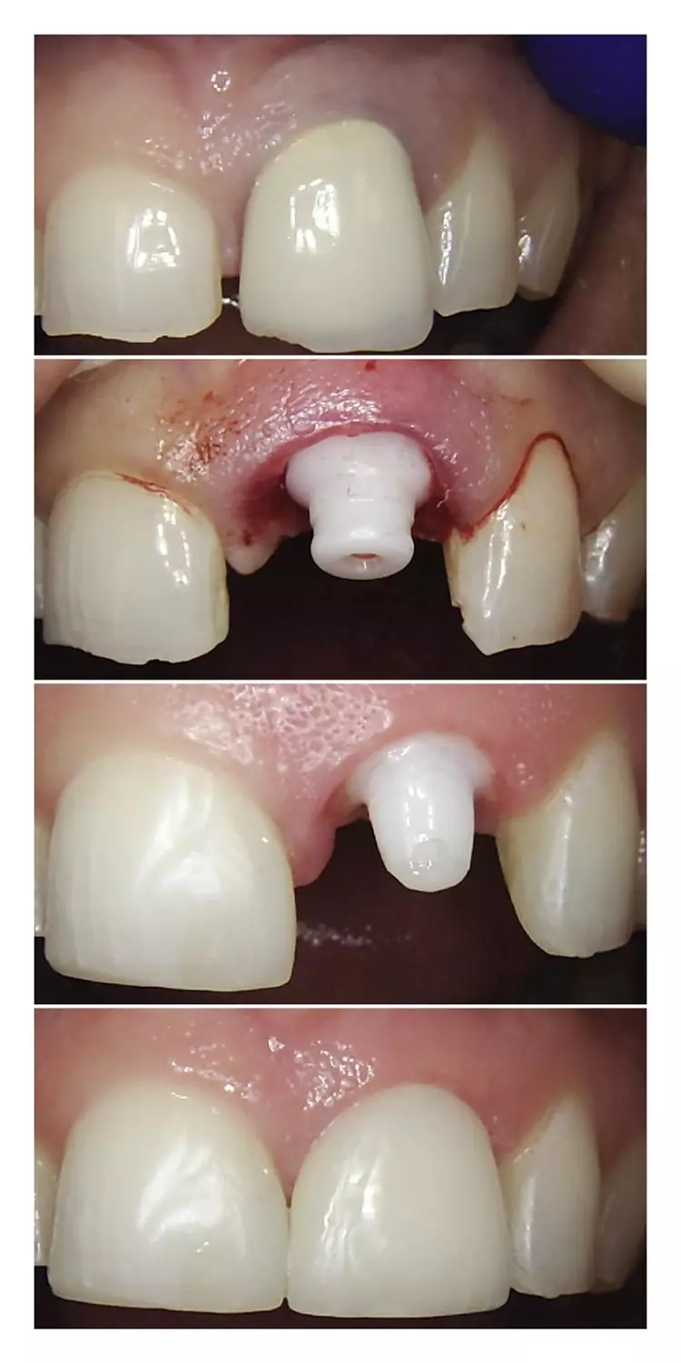 Abb. 6 a bis d: (a) Klinisches Erscheinungsbild der medialen Papille zwischen den
Zähnen 11/12 vor der Implantation, (b) klinisches Erscheinungsbild unmittelbar
nach der Implantation, (c) klinisches Erscheinungsbild der medialen Papille zwischen
den Zähnen 11/12 nach 4 Monaten Implantation und Sofortbelastung, (d)
klinisches Erscheinungsbild 36 Monate nach der Behandlung.