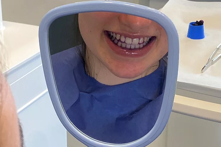 Beispielbild für die Sicht einer Patientin in den Handspiegel, um
angefärbte Plaque zu erkennen.
