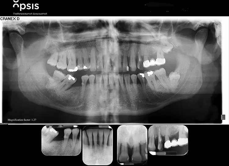 Abb. 2: Röntgenologischer Ausgangsbefund.