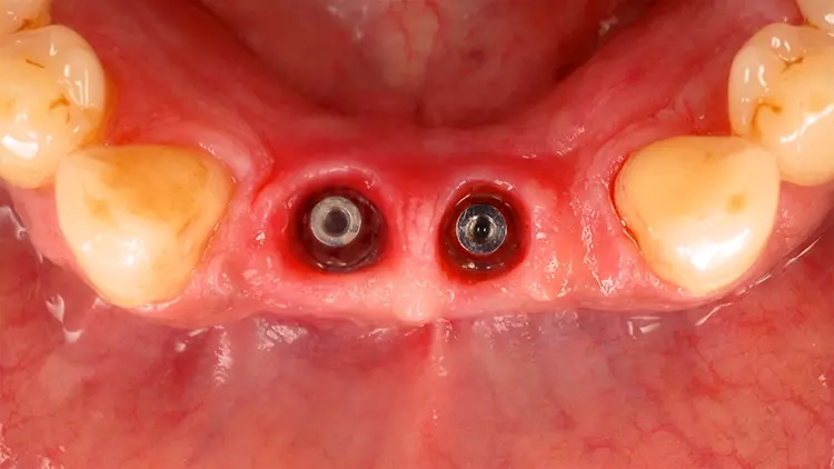 Abb. 20: Reizlose klinische periimplantäre Verhältnisse zum Zeitpunkt des Follow-
up nach Entfernung der verschraubten Suprakonstruktion im Unterkiefer.