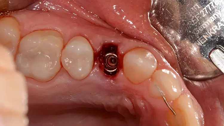 Abb. 11: Inseriertes Implantat (Straumann BL 4.1 mm,
Länge 10 mm) nach statisch navigierter Bohrung des
Implantatstollens