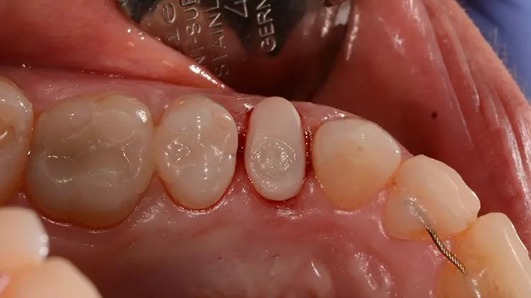 Abb. 12: Intraoperativ eingesetzter individueller
Gingivaformer, der simultan zur Implantatplanung
designt und anschließend additiv gefertigt wurde.