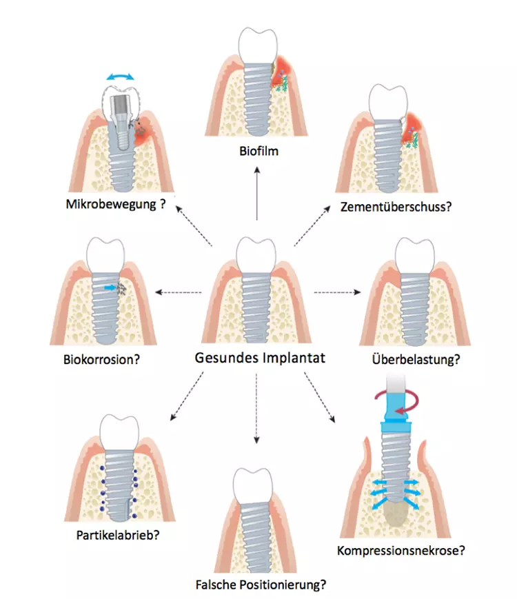 Abb. 2: Ätiologie der Periimplantitis. Neben dem mikrobiellen Biofilm an der Implantatoberfläche sind weitere mögliche Ursachen für periimplantären Knochenabbau derzeit nur ungenügend wissenschaftlich belegt. Modifiziert nach [17].