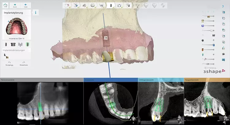 Abb. 2: Auswahl und Ausrichten des Implantates an der prothetischen Restauration. Im vorliegenden Fall
wurde eine Sofortimplantation in Regio 14 nach Längsfraktur des Zahnes geplant. Circumferent um das
Implantat wird ein Sicherheitsabstand von 1.5 mm angezeigt, welcher zu den Nachbarstrukturen nicht
unterschritten werden sollte. Gelb dargstellt ist eine Hülse für die statisch navigierte Implantation.