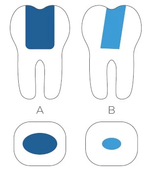 Um die Substanz des Zahnes zu schonen und damit seine Frakturanfälligkeit nicht unnötig zu erhöhen, lässt sich dank TruNatomy auch mit einer kleineren Zugangskavität (rechts) arbeiten. © Dentsply Sirona