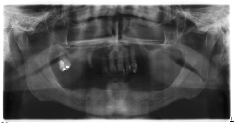Abb. 2: Geringes Knochenangebot im atrophierten Unterkiefer.