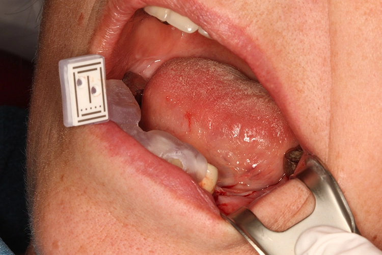 Abb. 2: Ausgangssituation mit zahngetragenem Marker-Tray und minimalinvasiver Schnittführung.