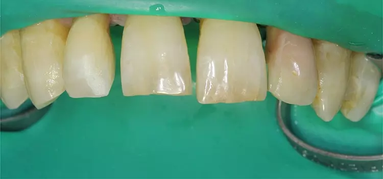 Abb. 2a: Ausgangslage nach parodontaler Initialtherapie.
