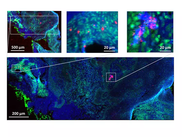 Abb. 3: Gezeigt sind Elementverteilungen von Phosphor (grün), Schwefel (blau) und Titan (rot) im periimplantären humanen Gewebe. Die Titanpartikel in diesem Ausschnitt haben eine Größe im Bereich weniger Mikrometer bis zu Größen deutlich kleiner als 1 ?m. Phosphor befindet sich vermehrt im Zellinneren, Schwefel dagegen auch in der extrazellulären Matrix. Diese Karten wurden an der Beamline ID21 am Synchrotron ESRF in Grenoble (Frankreich) aufgenommen.
