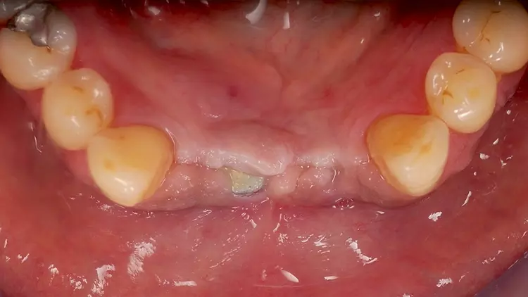 Abb. 3: Leichte Schleimhautdehiszenz in regio 41 ohne weitere Komplikationen
während der dreimonatigen Einheilphase.
