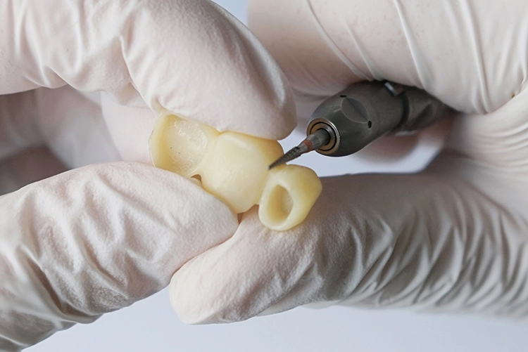 Abb. 16: Mit spitz zulaufenden, feinen Edelstahlfräsen wird Platz für die Papillen in den Interdentalräumen geschaffen.
