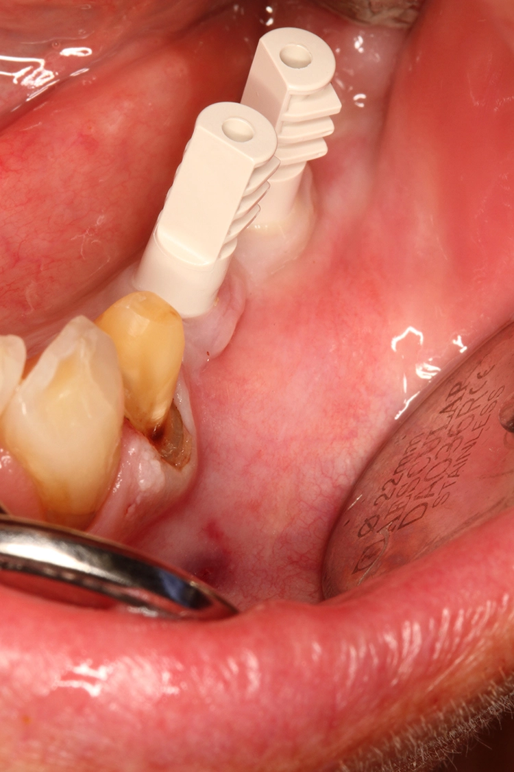 Abb. 10: Klinische Situation vier Monate nach Implantation und mit aufgesteckten Scanbodys.