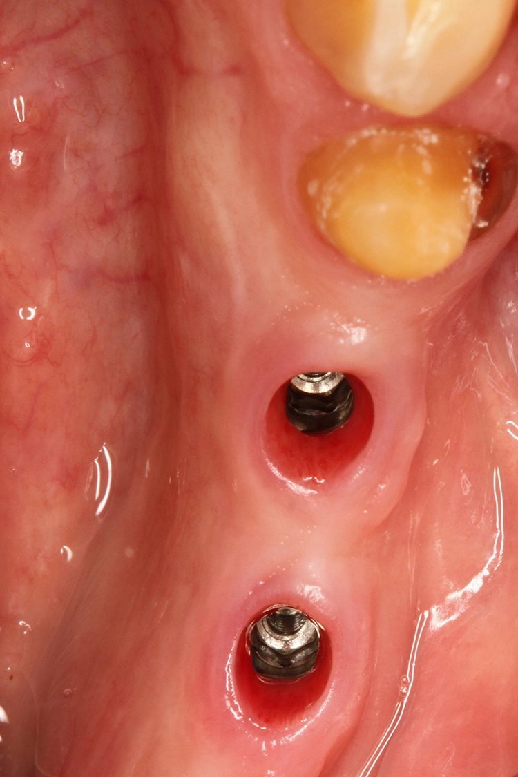 Abb. 12: Optimale Weichgewebssituation nach Entfernung der Gingivaformer.