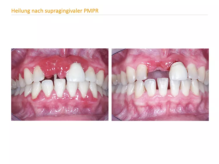 Abb. 3a u. b: (a) akute Gingivitis mit deutlich erkennbaren Gewebsvermehrungen und starker Blutungsneigung; (b) Zustand 4 Wochen nach Initialtherapie (supragingivales PMPR und Entfernung des Wurzelrestes Zahn 11).
