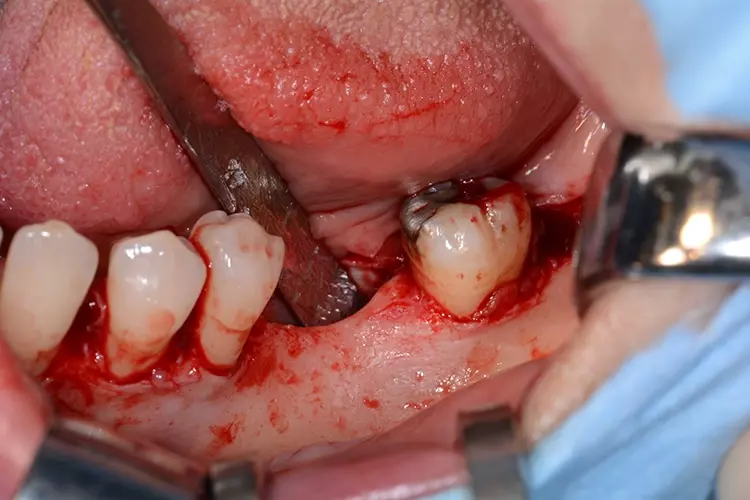 Abb. 3: In der intraoperativen Ansicht zeigt sich ein ausgeprägter horizontal atrophierter Alveolarkamm regio 37 und 36.