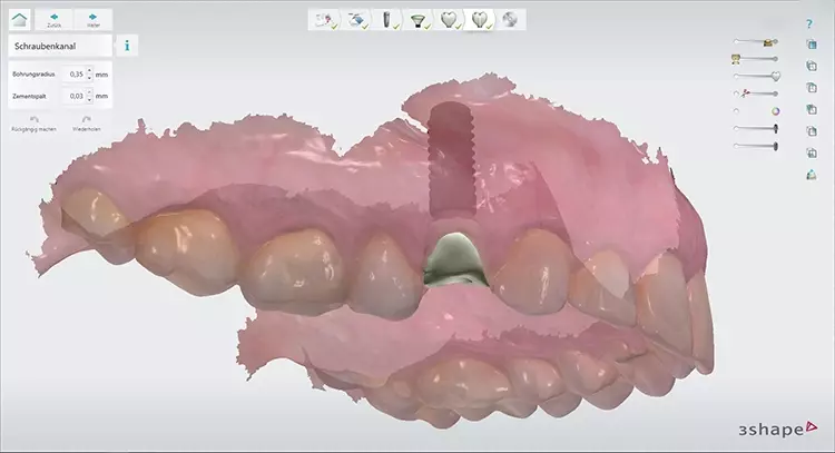 Abb. 3: Designter Gingivaformer für die Sofortversorgung des Implantates.