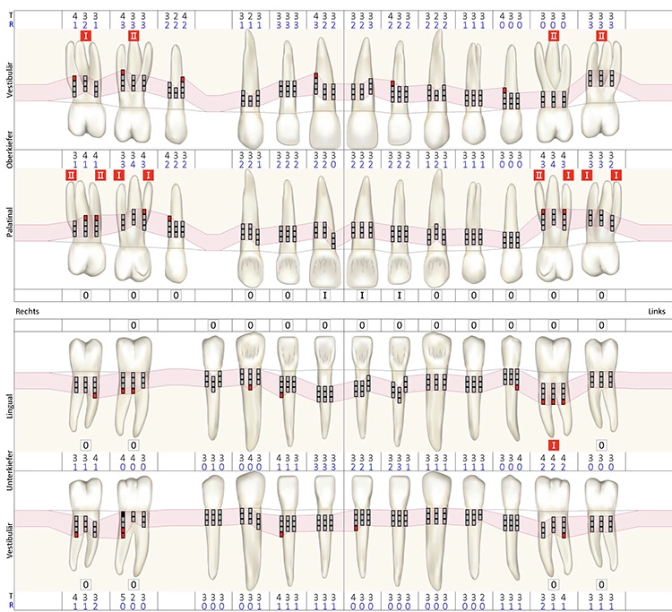 Abb. 3a: Parodontalstatus (PA-Konzepte Voice GmbH, Sendenhorst, Deutschland) bei der Reevaluation nach antiinfektiöser Therapie (Mai 2019).