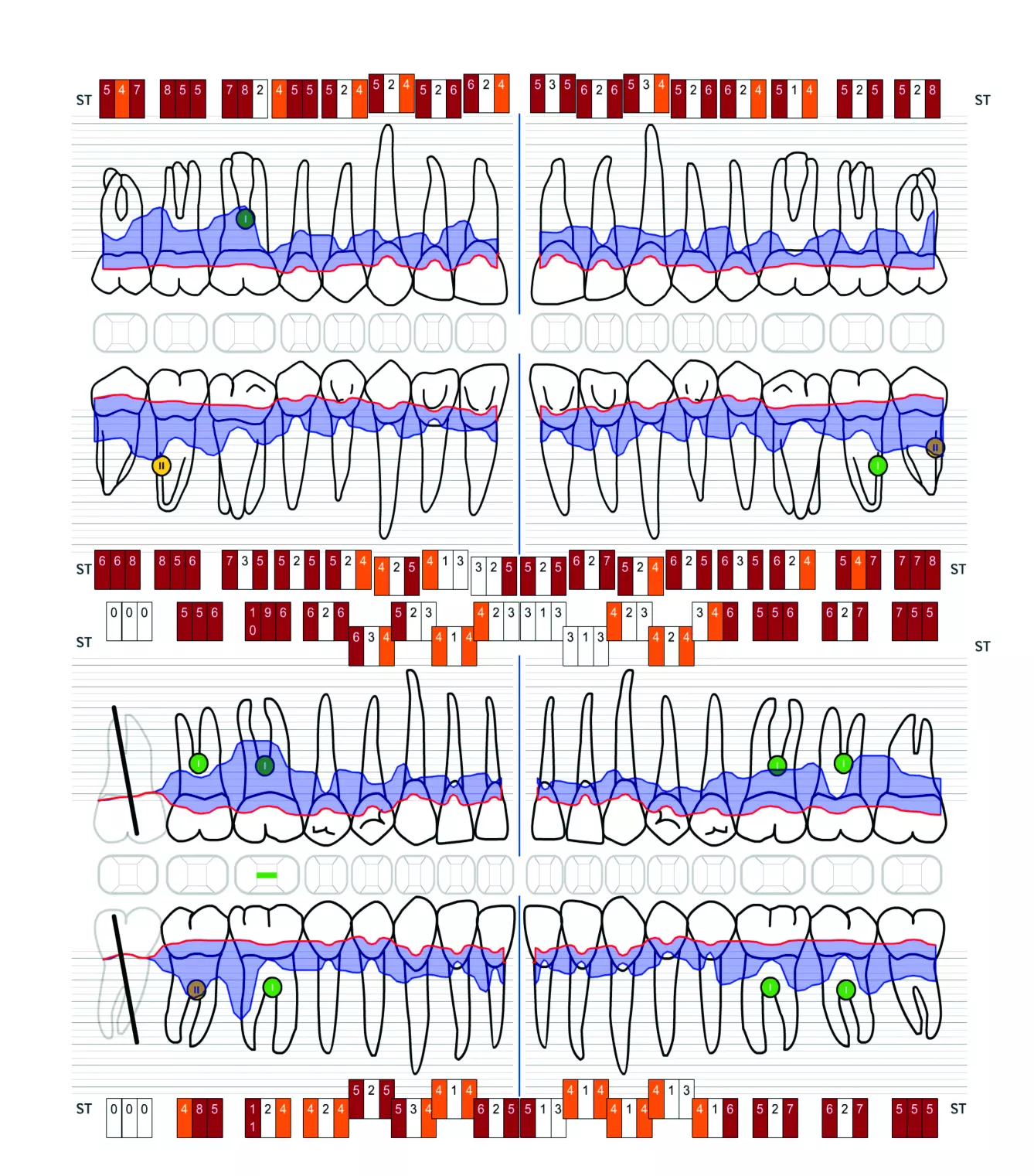 Abb. 3b: Beispiel für parodontale Destruktionen, die sich nach jahrelanger Nulltherapie einstellten. Es waren lediglich professionelle Zahnreinigungen erfolgt.