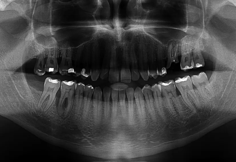 Abb. 3c: Beispiel für parodontale Destruktionen, die sich nach jahrelanger Nulltherapie einstellten. Es waren lediglich professionelle Zahnreinigungen erfolgt.