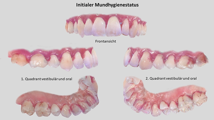 Abb. 4: Bilder vom 3D-Intraoralscan mit initialem Mundhygienestatus nach
habituellem Zähneputzen. Im Oberkiefer sind die Vestibulärflächen der Frontzähne
fast plaquefrei. Defizite sind vestibulär-distal an den Approximalflächen und an
den Oralflächen zu erkennen.