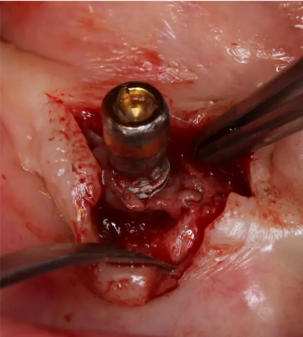 Abb. 4: Periimplantitis mit typisch aussehendem Entzündungsgewebe periimplantär. Dieses Gewebe wurde entnommen und histologisch analysiert.
