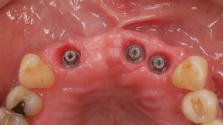 Abb. 4: Zustand zum Zeitpunkt der provisorischen Versorgung im Oberkiefer.