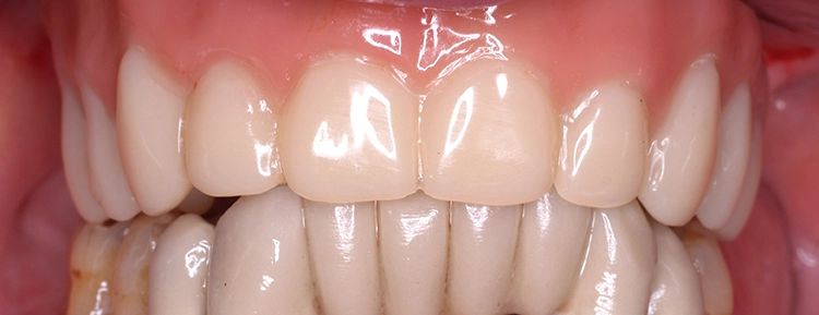 Abb 9: Postoperative Panoramaschichtaufnahme.