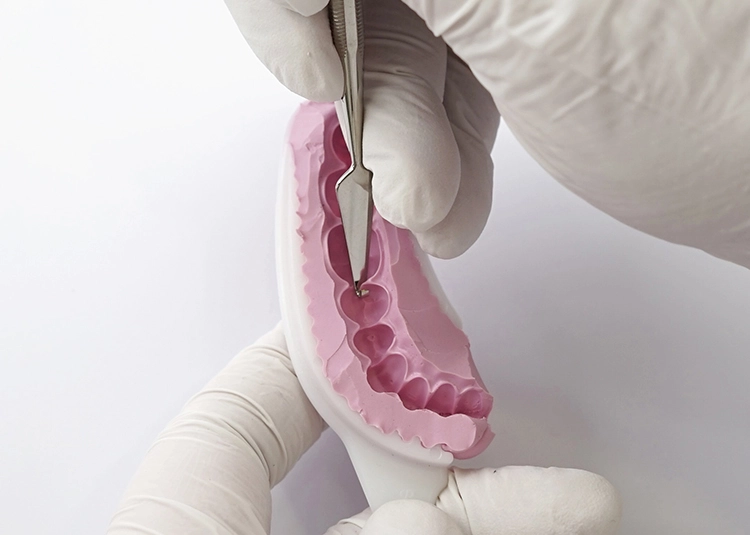 Abb. 4: Vorsichtiges Entfernen der Inderdentalsepten.