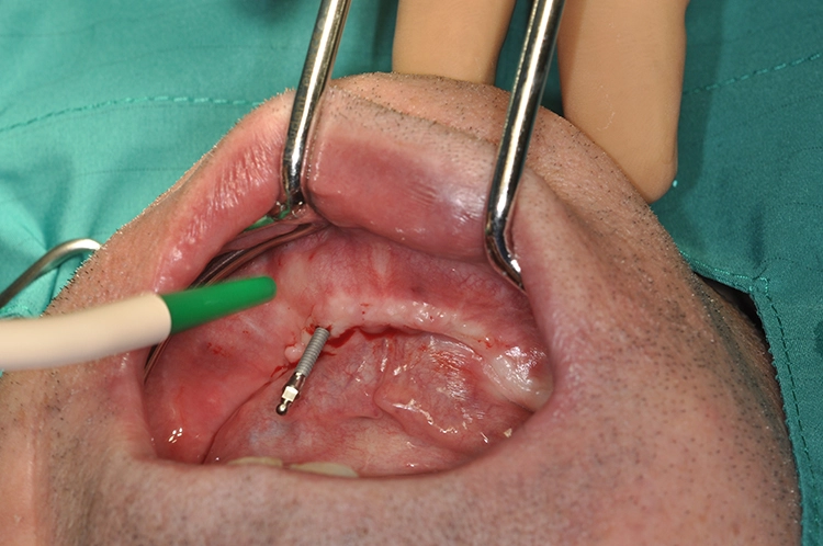Abb. 4: Minimalinvasive Direktinsertion der Miniimplantate „flapless“ ohne Lappenbildung.