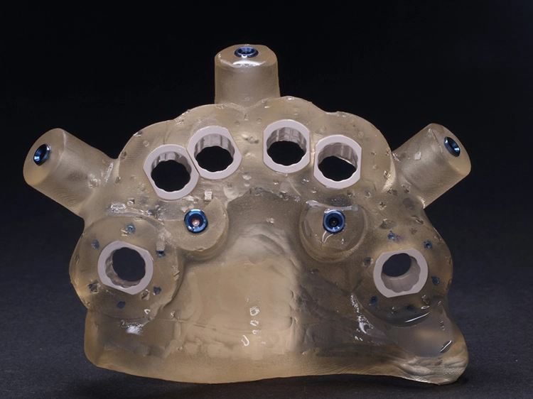 Abb. 5: OP-Schablone und präfabriziertes Provisorium.