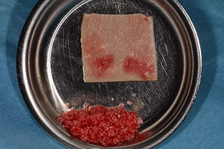 Abb. 4c: Augmentationsmaterial bestehend aus einer Mischung von autologem Knochen und xenogenem Knochenersatzmaterial, mit i-PRF biologisierte Kollagenmembran.